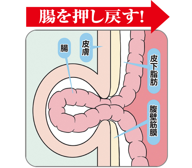 脱腸サポーター・腸あんしん