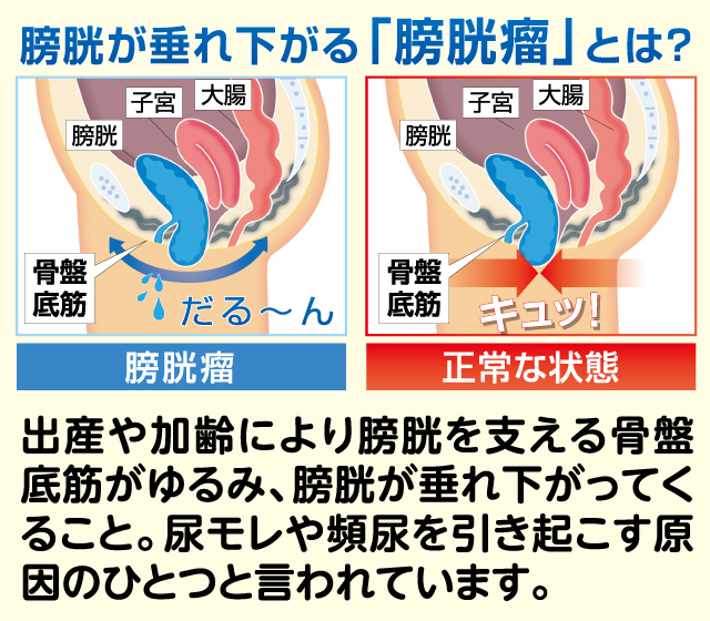 骨盤底筋ベルト・モレナレディ2枚組