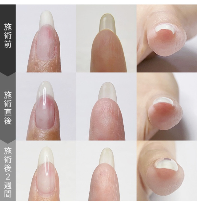 巻き爪　FLAT GEL 3本セット WSPT＞ 巻き爪ケア フラットケアジェル 3本セットの通販｜セブン