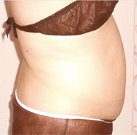 Before（右腹部）