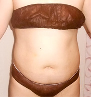 Before（左腹部）