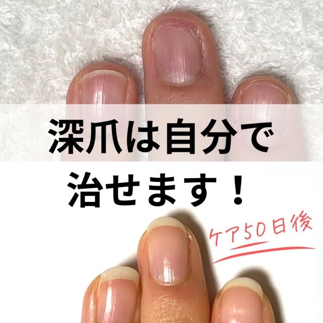 宅配送料無料】◇深爪卒業ケアセット 自然な仕上がり◇爪強化剤 ネイル