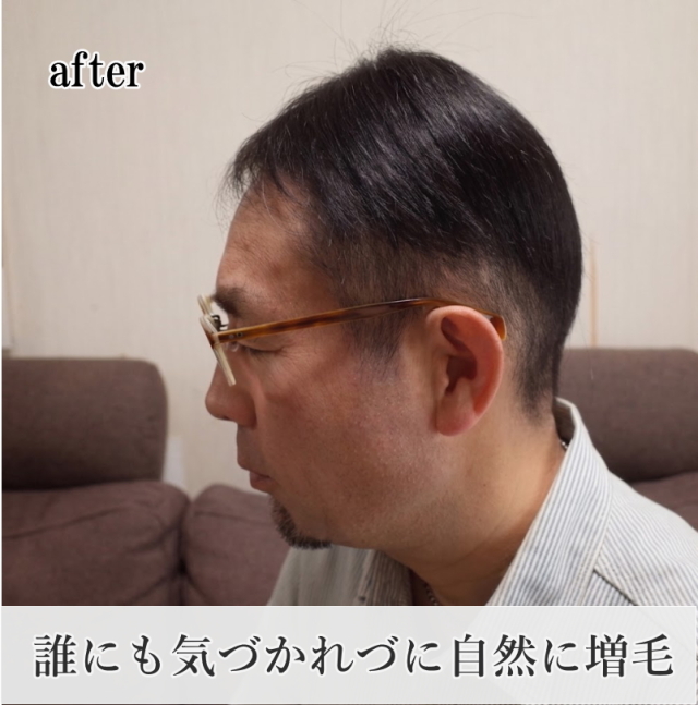 男性用メンズ部分ウィッグMサイズ 人毛100% 圧倒的な自然さで視線が気