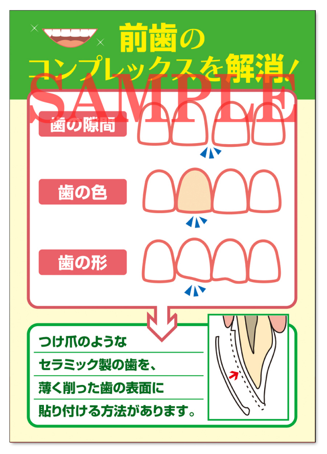 POS017　ラミネートベニアＰＲ用ポスター（A3サイズ）