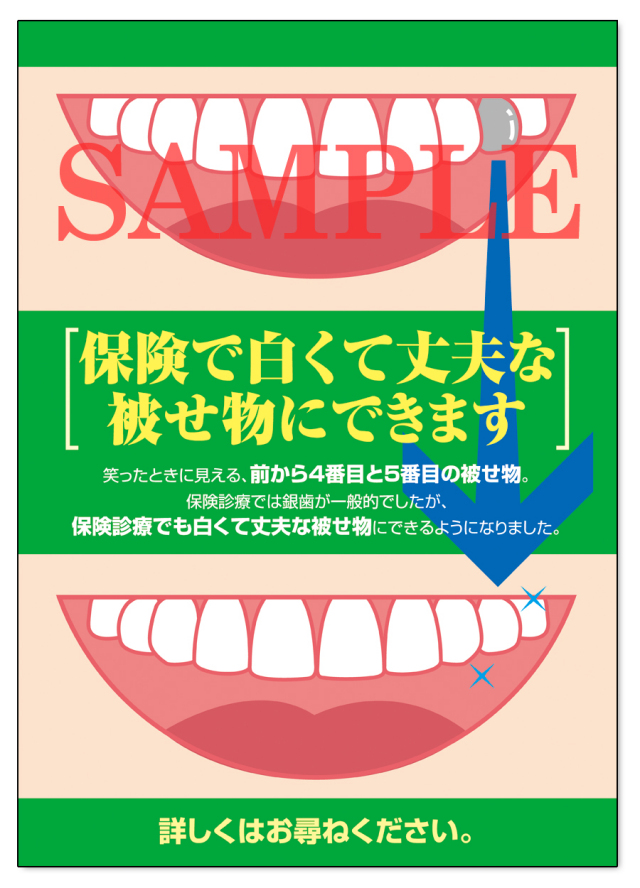 POS024　CAD/CAM保険適用ポスター（A3サイズ）