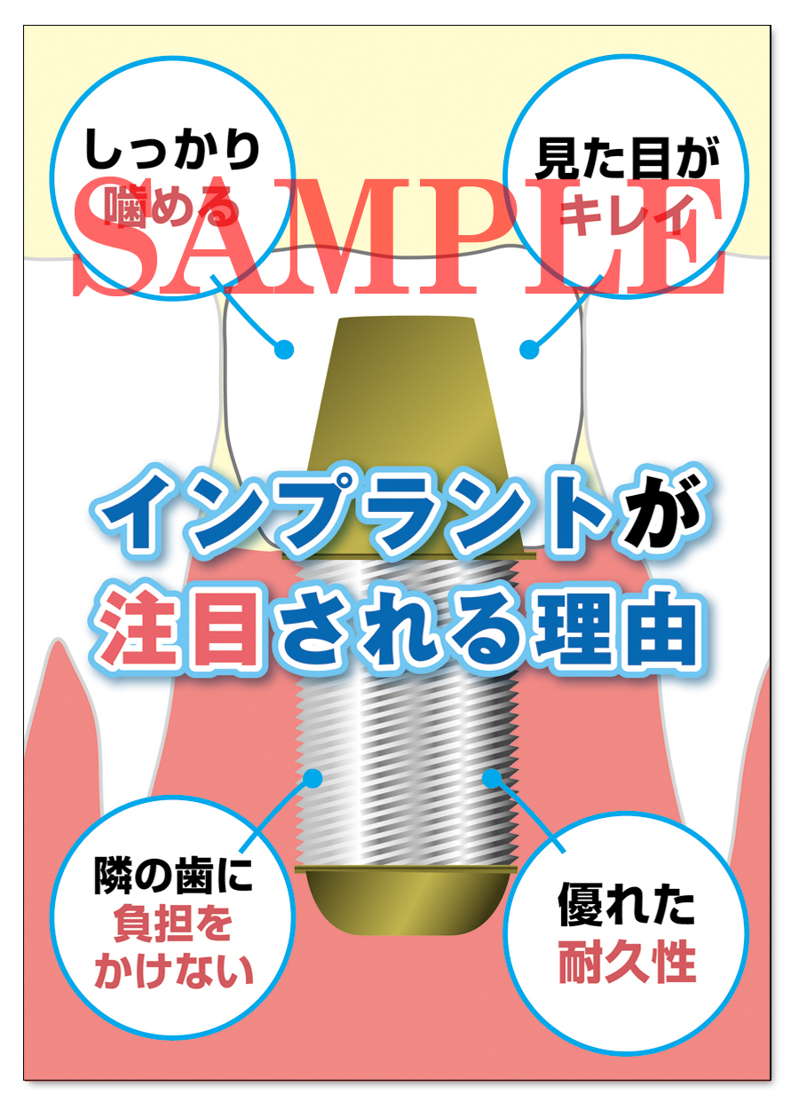 POS016　インプラント（2）ＰＲ用ポスター（A3サイズ）