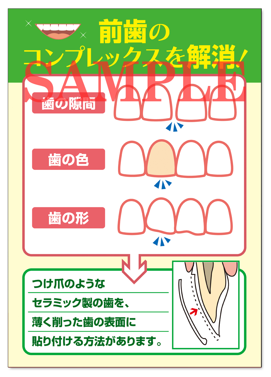 POS017　ラミネートベニアＰＲ用ポスター（A3サイズ）