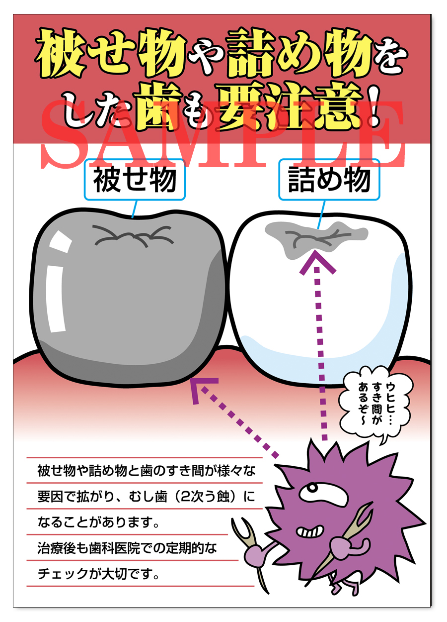 POS021　2次う蝕にご注意ポスター（A3サイズ）