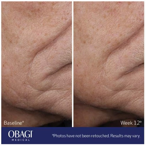 (Obagi)エラスティダーム　リフトアップ　＆　スカルプ　ファイシャル　モイスチャライザー　BeforeAfter1