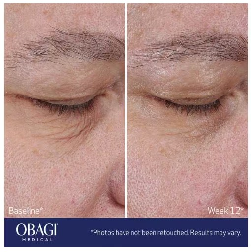 (Obagi)エラスティダーム　リフトアップ　＆　スカルプ　ファイシャル　モイスチャライザー　BeforeAfter2