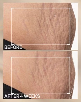 StriVectin SD Advanced PLUS Intensive Moisturizer 2